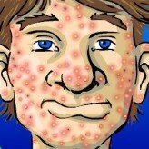 acne be gone – the game game